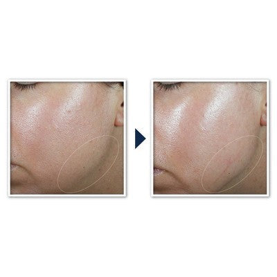 RoC Derm Correxion Contour Cream for Face & Neck