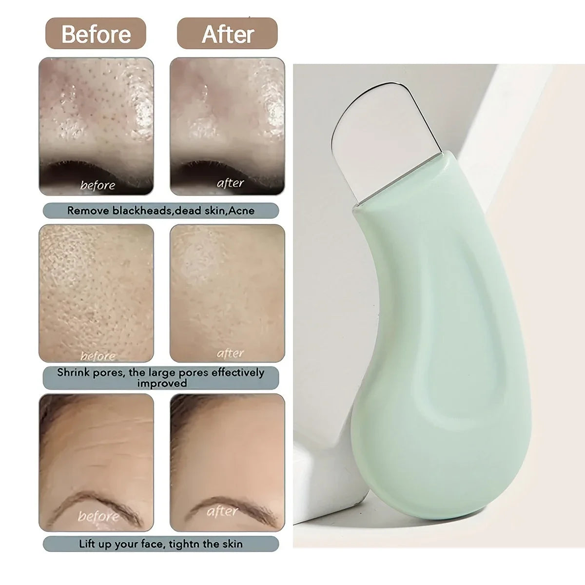 Blackhead & Whitehead Removal Tool